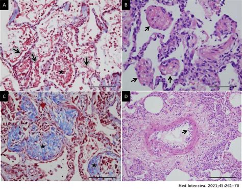 Histopathological Features In Fatal Covid 19 Acute Respiratory Distress