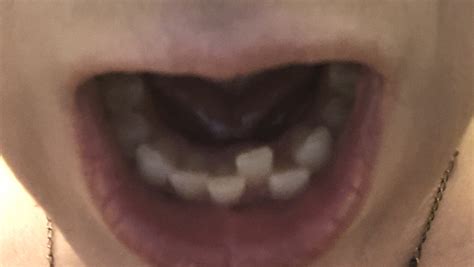 Is My Tooth Too Crooked For Invisalign R Invisalign