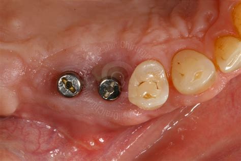 Maxillary Sinus Grafting Fraschini Chirurgia Orale