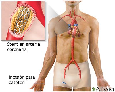 Stent de arteria coronaria MedlinePlus enciclopedia médica