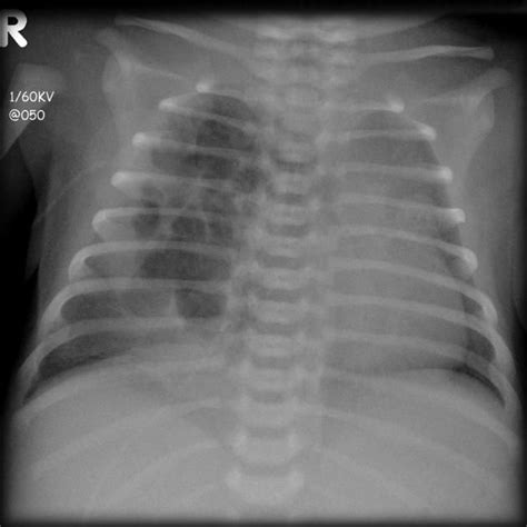 Congenital Cystic Adenomatoid Malformation Radiology Case Pulmonary Chest