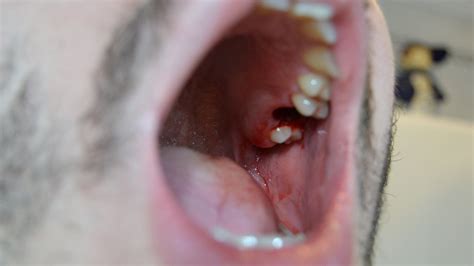 Wisdom Teeth Removal Hole