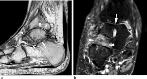 Sinus Tarsi And Sinus Tarsi Syndrome An Imaging Review European