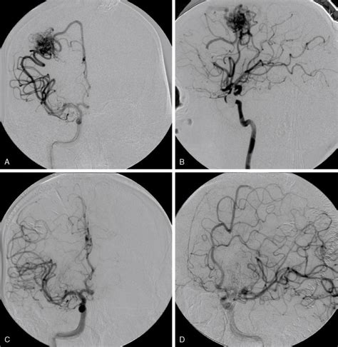 Craniotomy For Resection Of Intracranial Cortical Arteriovenous Malformation Neupsy Key