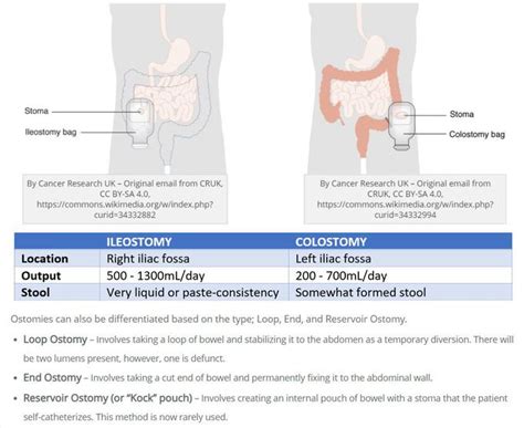 Colostomy Vs Ileostomy Medizzy