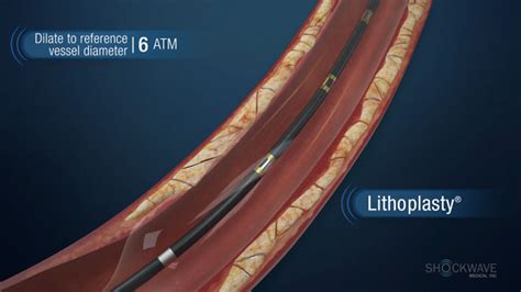 Shockwave Medical Announces FDA Clearance Of The Companys Lithoplasty