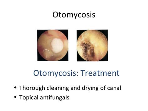 Infections Of The External Ear