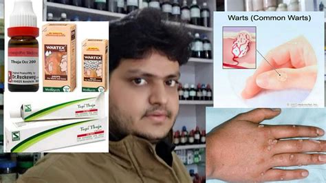 Homeopathic Medicine For Warts Removal On Face Neck Finger Feet Explain