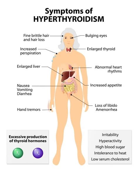 A Look At Hyperthyroidism Overactive Thyroid The Best Of Health