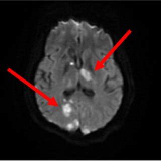 Mri Brain With Contrast Axial Diffusion Weighted Image Showed