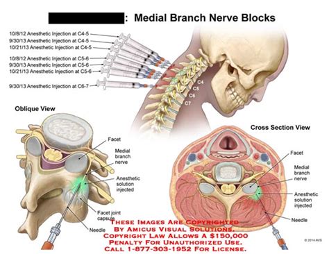 Medial Branch Nerve Blocks