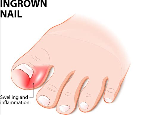 Ingrown Toenail Causes, Remedies And Treatment, 41% OFF