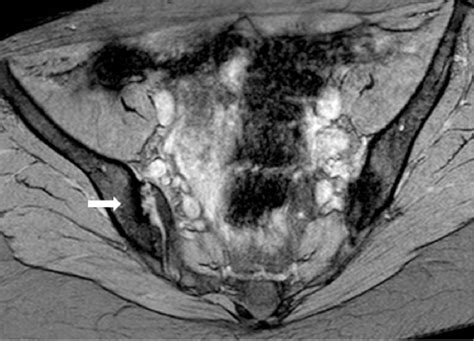 Sacroiliitis – Findings on Conventional Radiography, CT and MRI studies ...