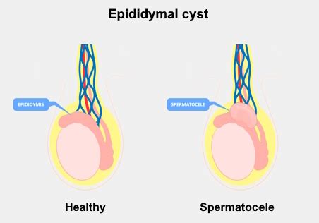 Lumps Swelling And Pain In The Testicles And Scrotum