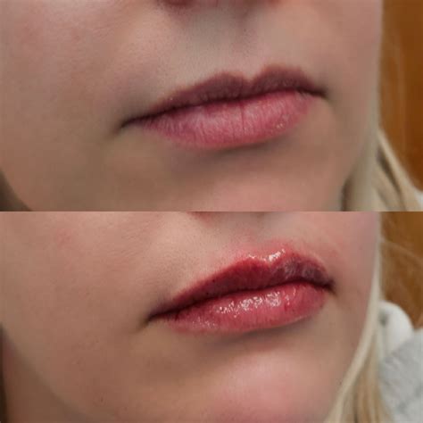 How much are Lip Filler in NJ | Lip Injections NJ - Berlin Beauty