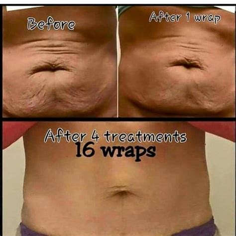 Look At These Amazing Results From The Wraps Skin Tightening