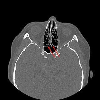 Axial CT scan illustrating the presence of the left and right sphenoid ...