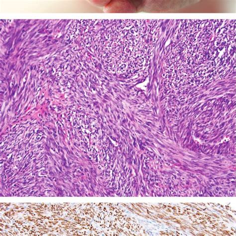 Ulcerated Tumors A Cell Rich Tumor Composed Of Fascicles Of Atypical