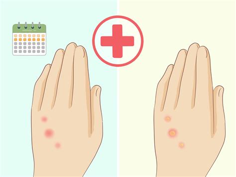 How to Treat Bed Bug Bites: 12 Steps (with Pictures) - wikiHow