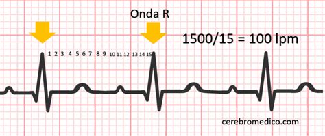 How To Determine Heart Rate On Ecg Cerebro Medico