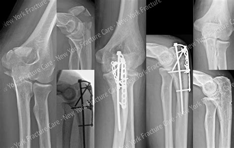 Olecranon fracture (upper extremity) - New York Fracture Care