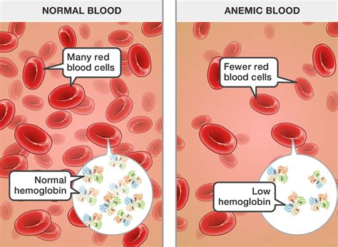 Treatment of anemia with stem cell at UCTC. Chronic anemia treatment ...