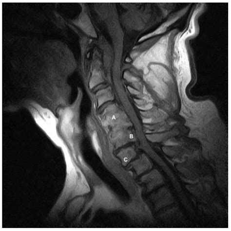 Recognition of Prodromal Hypoglossal Nerve Palsy Presenting with Neck