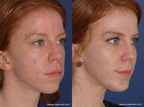 Cheek Implant Before And After Weber Facial Plastic Surgery