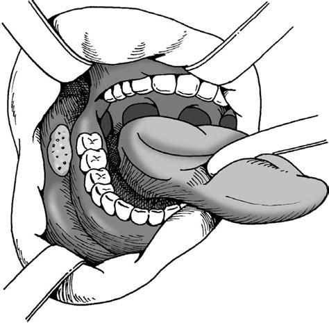 Figure 1 From Cancer Of The Buccal Mucosa And Retromolar Trigone