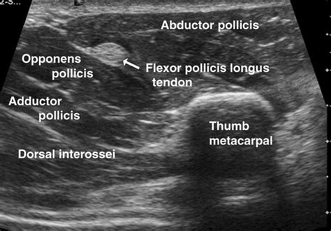 Normal Sonographic Anatomy Of The Wrist And Hand Radiographics