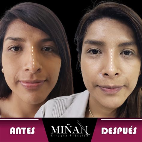 Rinoplastia Cirug A De Nariz Galer A Cirug A Pl Stica En Lima Per