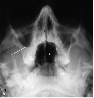 Floor Of The Nasal Cavity Radiograph