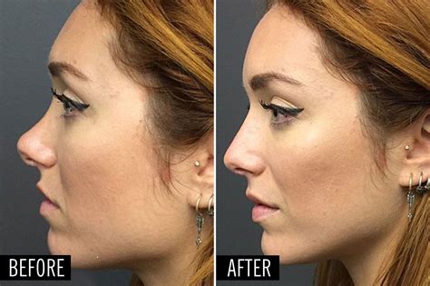 How A Plastic Surgeon Can Make This Nose Job Happen In 5 Minutes Nose