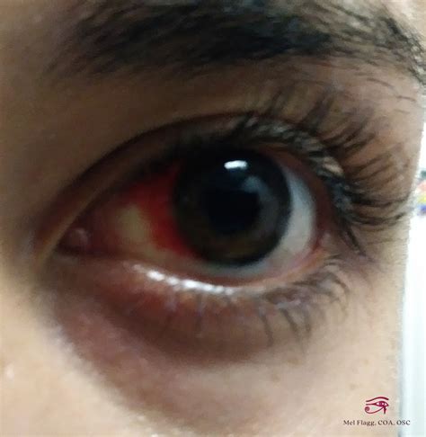 Subconjunctival Hemorrhage: Broken Blood Vessel in the Eye - YouMeMindBody