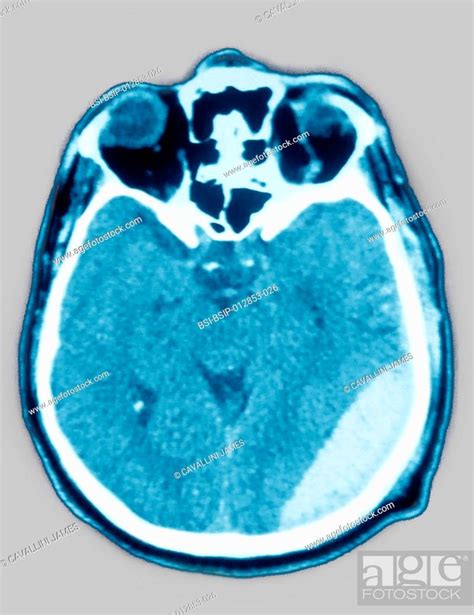 Cerebral Ct Scan Showing Epidural Extradural Hematoma A Type Of