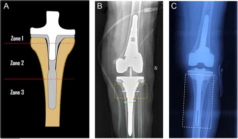 Hinged Knee Replacement After Revision