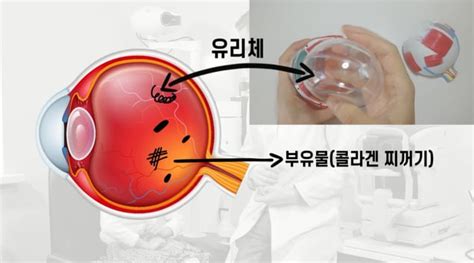 망막 박리 비문증 치료약 주의사항 7가지