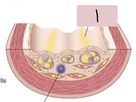 Pathology Of Atherosclerosis Flashcards Quizlet