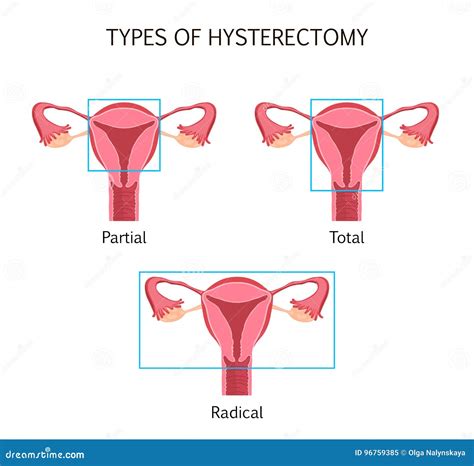 Types Of Hysterectomy Stock Vector Illustration Of Background 96759385