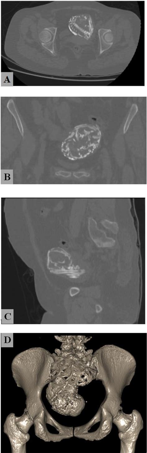 A Pelvic CT Scan Shows A Calcified Mass In The Pelvic Cavity In These