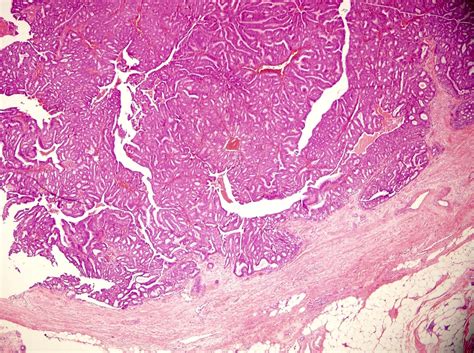 Pathology Outlines Who Classification