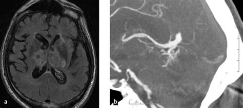 5 Cerebral Arteriovenous Malformations Avms And Dural Arteriovenous Fistulas Davfs