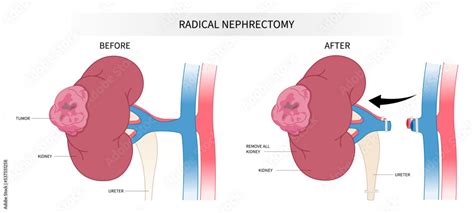 Kidney Donation With Laparoscope Minimally Invasive Surgery Of