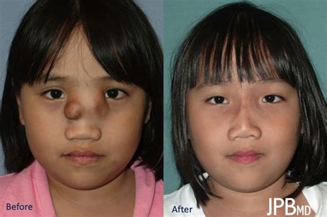 Craniofacial Surgery Before After Photos James P Bradley MD