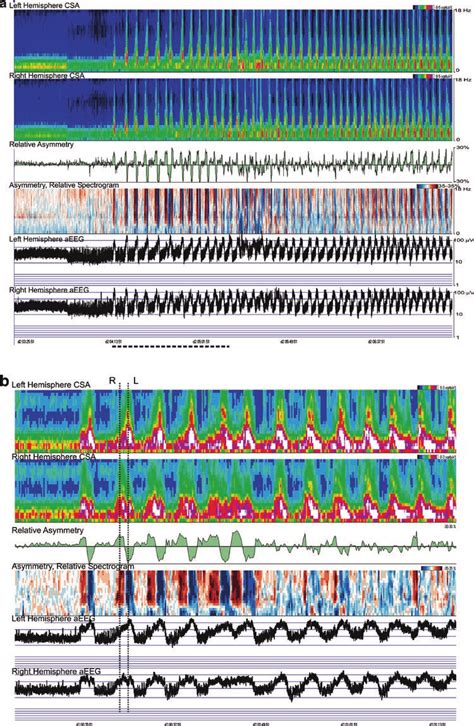 Using Quantitative Eeg Tools To Aid Review And Interpretation In A