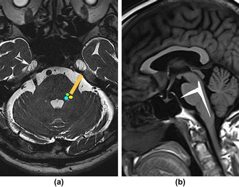 The Trigeminal Nerve An Illustrated Review Of Its Imaging Anatomy And