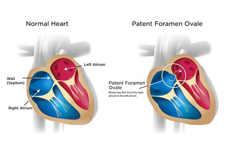 Patent Foramen Ovale My Doctor Online