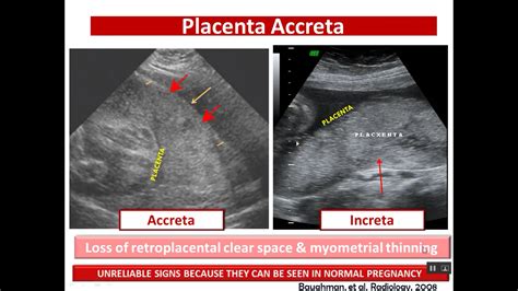 Surgery To Remove Placenta After Birth