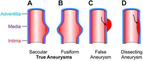 Dissecting Aneurysm