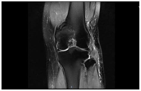 Fibular Collateral Ligament Mri